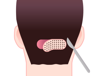 Scalp Harvesting