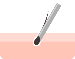 Transplantation