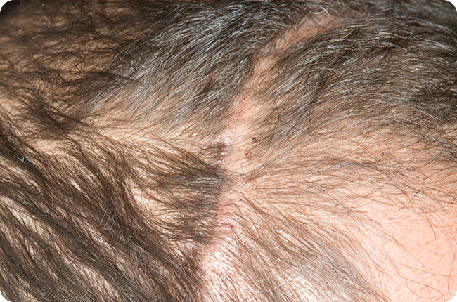 Scar Transplant