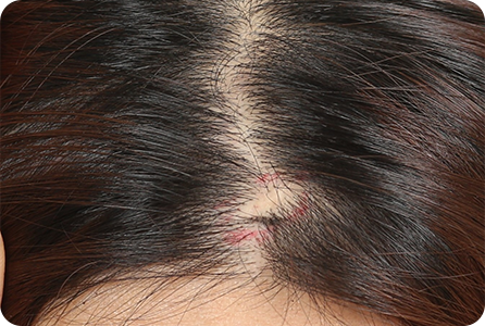 Scar Case 1
