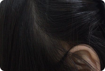 Scar Case 4