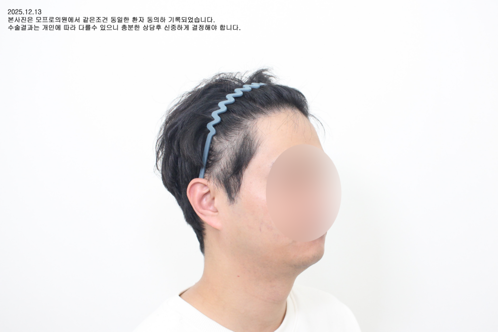 After : 30대중/남/비절개 4069모