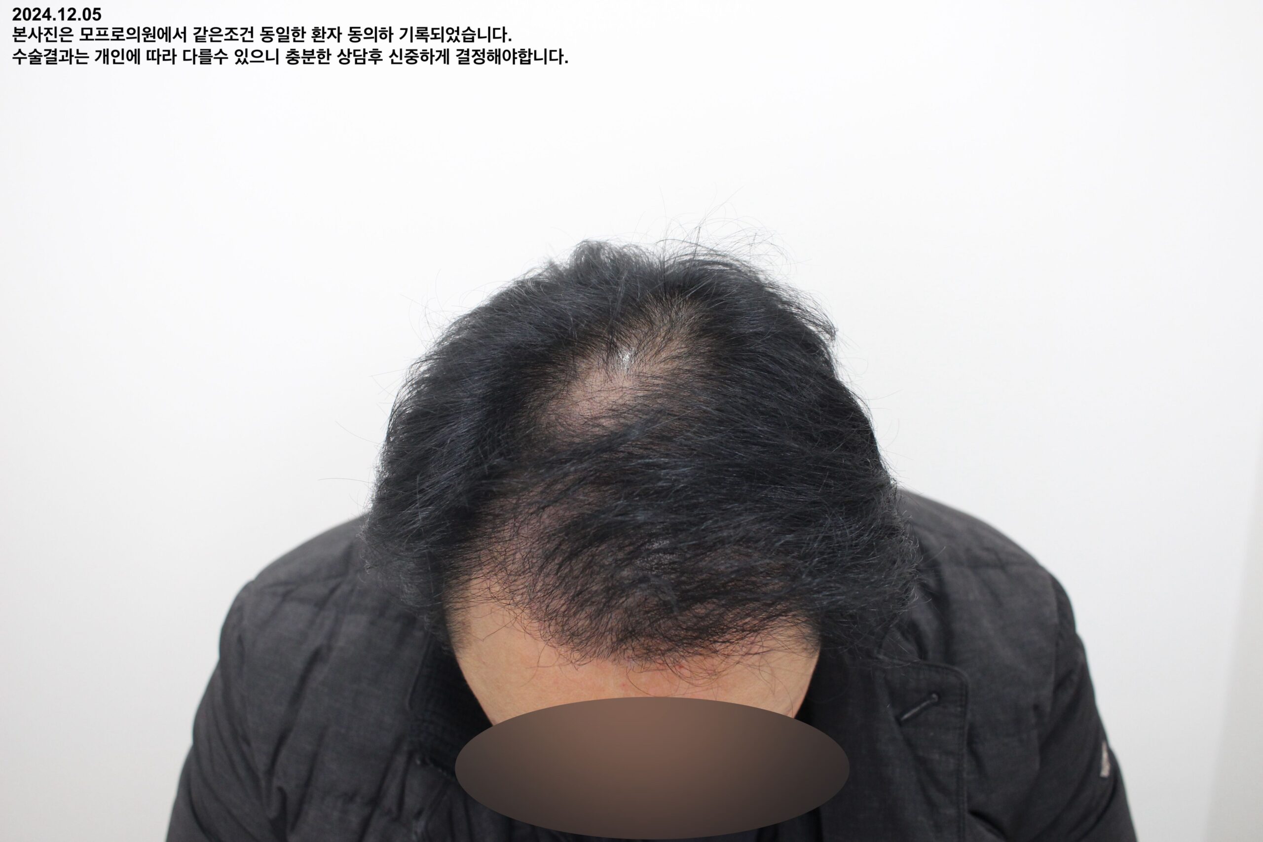 Before