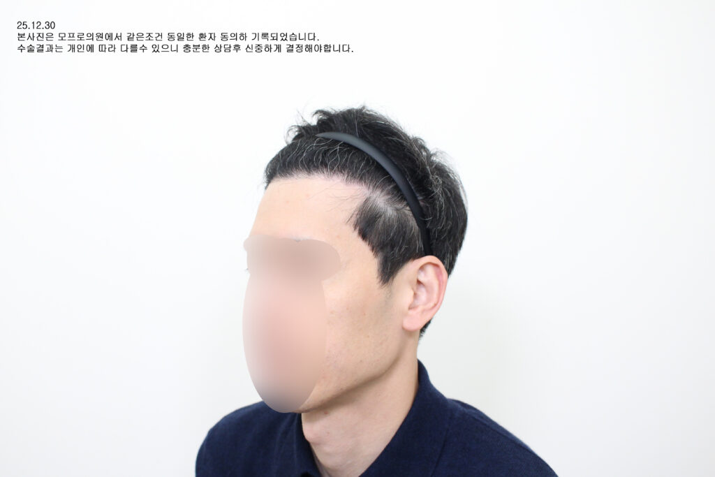After : 40대 중반/남/재수술/절개 4079모