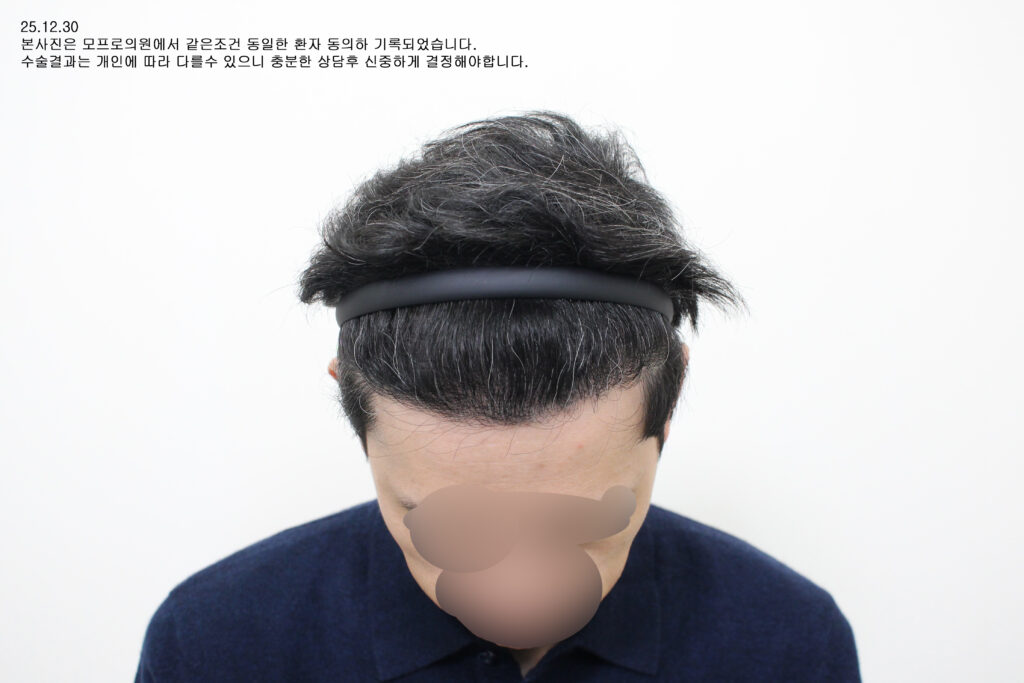 After(전면위) : 40대 중반/남/재수술/절개 4079모