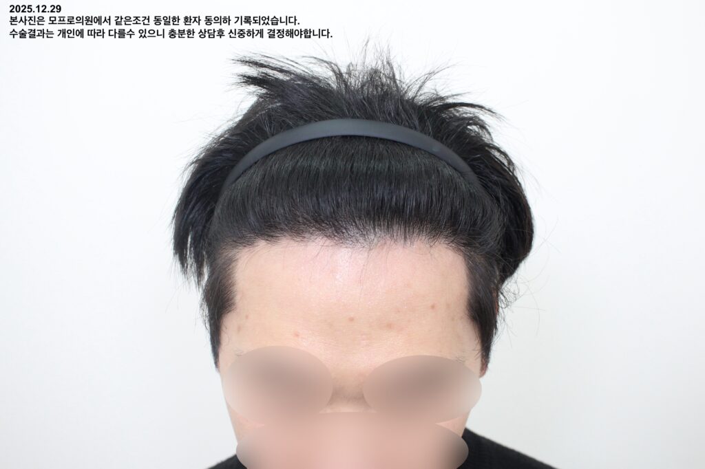 After 30대 초 남성 비절개 2988모