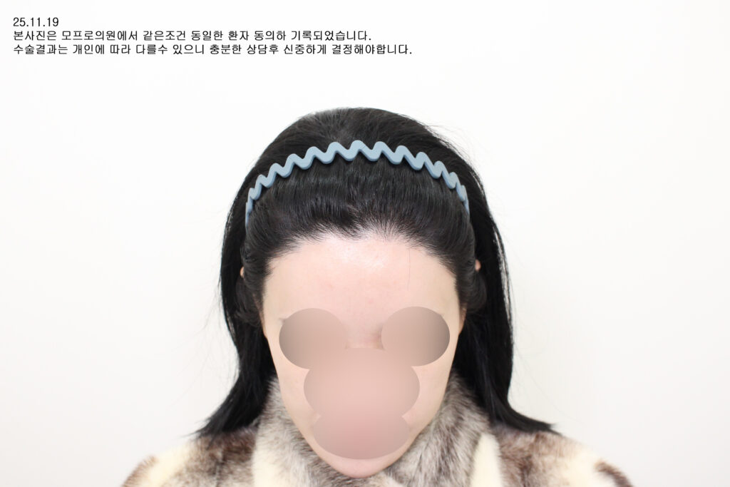 after : 30대 여자 절개+비절개 4200모