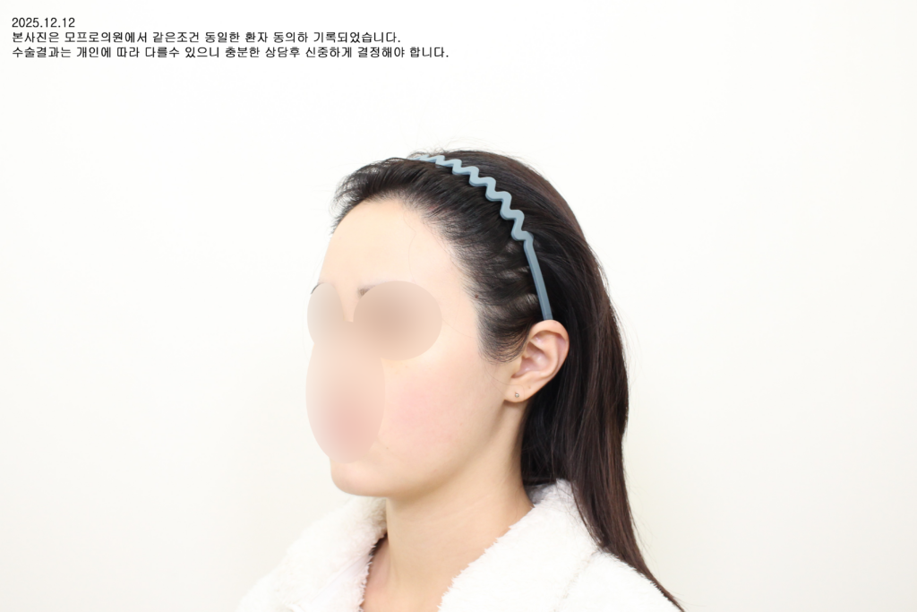 After 10대 후반 여성 헤어라인교정 절개 4088모